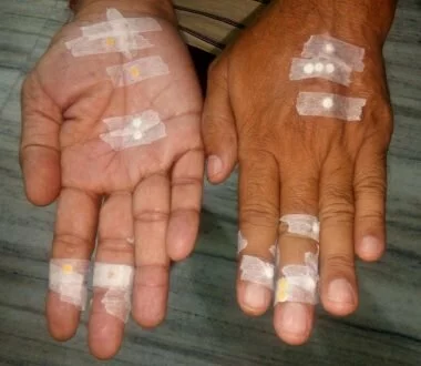 बिना गोली, दवाई व इंजेक्शन के चुम्बकीय एक्युप्रेसर द्वारा निशुल्क इलाज का कैंप सुमेरपुर में – आज दूसरा दिन